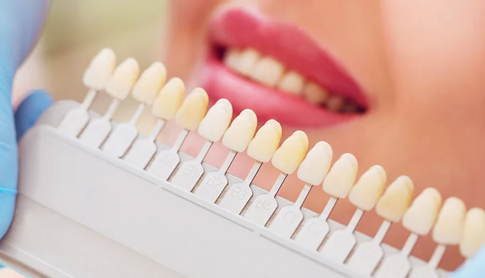 Getting Veneers: The Process and Recovery in Turkey